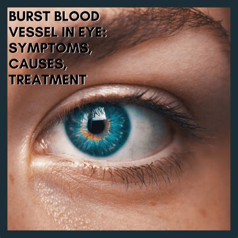 Popped Blood Vessel in Eye: Causes, Treatment, .